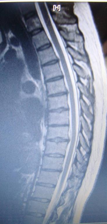 thoracic disc herniation treated by New Roads chiropractor